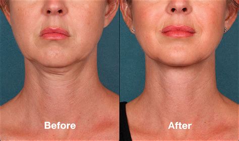 Liquid Lift Treatments In Atlanta Ga Buckhead Plastic Surgery