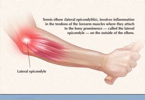 Elbow Pain and Tennis Elbow from Repetitive Strain Injury - Chris ...