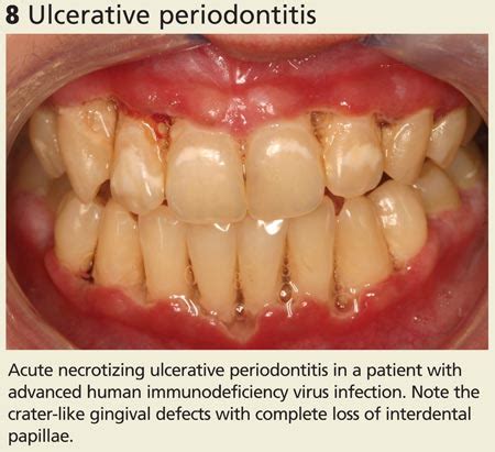 Necrotizing Ulcerative Gingivitis