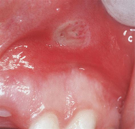 Recurrent Oral Ulceration Aphthous Like Ulcers In Periodic Syndromes