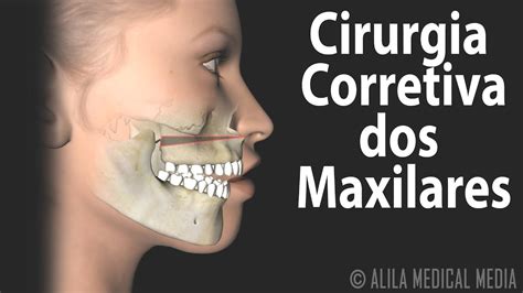 Íngua No Maxilar O Que Fazer - Como Tratar Ingua No Maxilar - Dibujos Cute Para Imprimir