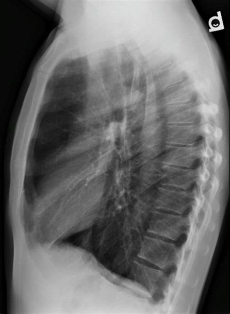 Radiografia De Tórax Com Enfisema