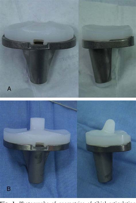 Figure 1 From A Recession Of Posterior Cruciate Ligament In Posterior