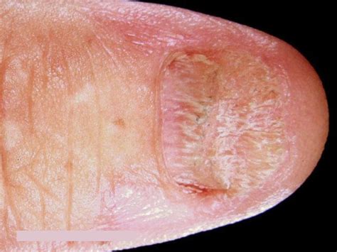 Lichen Planus Causes What It Looks Like And How To Get Rid Of It