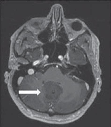 Case study 2: MRI T1 axial view showing cerebellar pilocytic ...