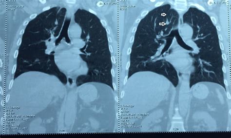 Chest Medicine Made Easy Dr Deepu Chest Radiology A Case Of Azygous Lobe