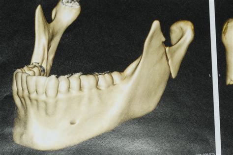 Cóndilo Mandibular