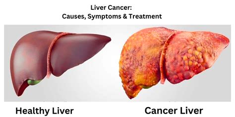 Liver Cancer: Causes, Symptoms and Treatment - SINGHLAMEDICOS.CO.IN