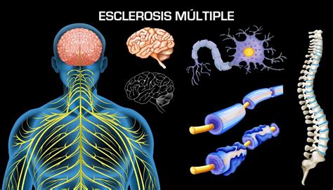 30 De Mayo Día Mundial De La Esclerosis Múltiple Andalucía Médica