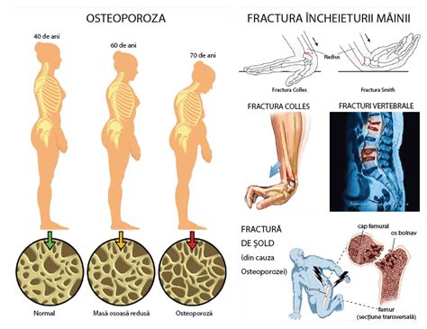 Osteoporoza Simptome Cauze Si Tratament Sfaturimedicale Ro 2022 41958