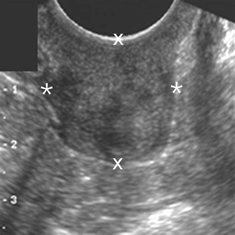 Gray Scale And Color Doppler Sonographic Features Of The Vaginal Cuff