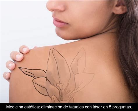 Medicina Est Tica Eliminaci N De Tatuajes Con L Ser En Preguntas