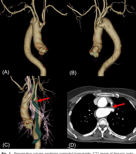 Figure From Hybrid Repair Of Kommerell Diverticulum And Aberrant