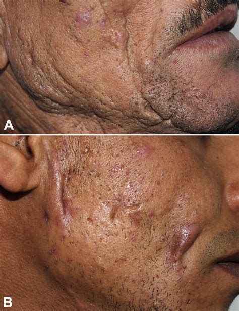 Facial Hidradenitis Suppurativa A Potential Mimicker Of Acne Vulgaris