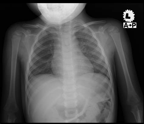 Closed Fracture of Right Clavicle – UNI CLINIC