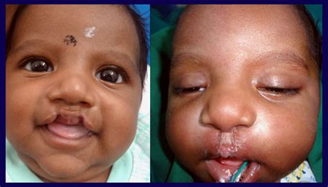 Bilateral Cleft Lip And Palate Before And After