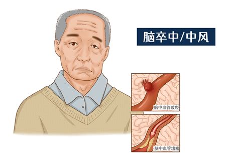 中风“猛于虎”！防治脑卒中，厦门市中医院大型义诊千万不要错过！ 患者 在线 活动