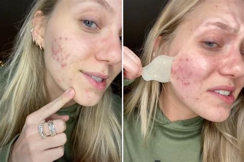 Do Hydrocolloid Bandages Heal Acne Doctor Verifies Tiktok Hack