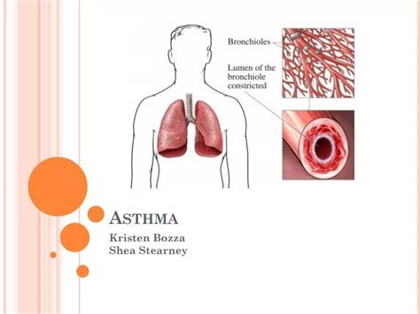 Ppt Asthma Powerpoint Presentation Free Download Id 2644055