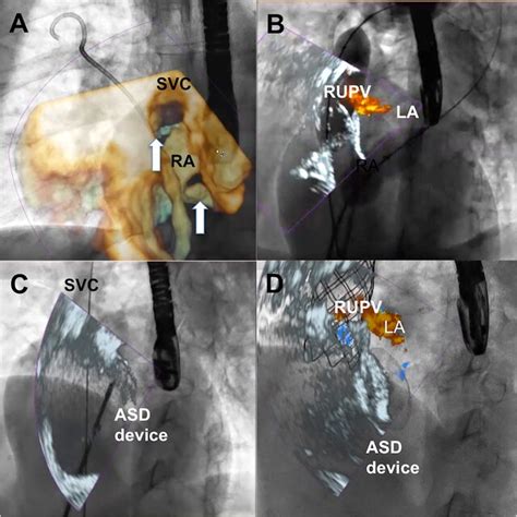 Fusion Of Three Dimensional Transesophageal Echocardiography And