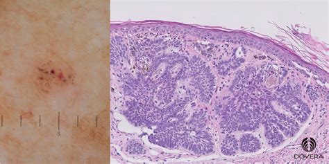 Como Interpretar O Resultado Da Biópsia De Um Carcinoma Basocelular