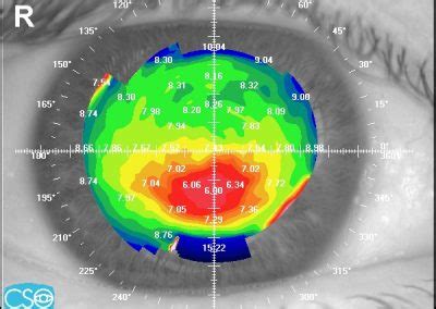 Topografia Mappa Corneale Ottica Micaglio Valentino