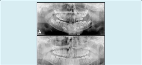 Panoramic Radiographs From Case 2 Taken During Mixed Dentition 8