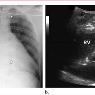 The Clamshell incision. In this picture the pericardium has been ...