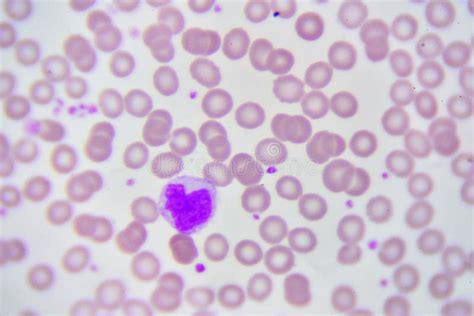 Monocyte Cell Stock Photo Image Of Leukemia Analyzing 92593956