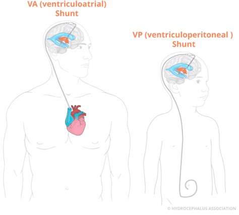 What Is Normal Pressure Hydrocephalus Nph