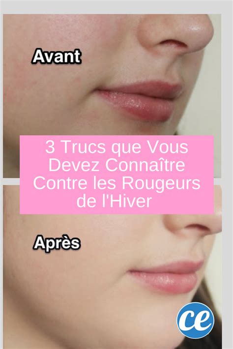 Vous Cherchez Un Rem De Pour Lutter Contre Les Rougeurs Sur La Visage