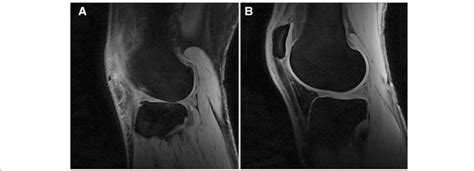 Lateral Compartment Of Male Participants With A Full Thickness