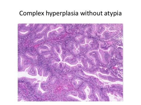 Endometrial Hyperplasia Without Atypia