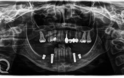 Implantes Cortos Rehabilitando Sectores Posteriores Inferiores