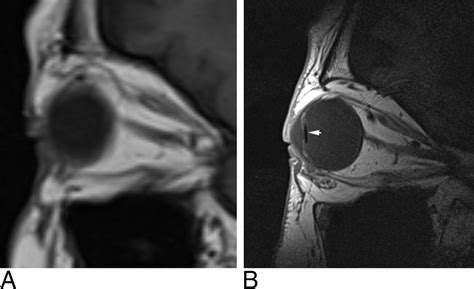 MR Eye High Resolution Microscopy Coil MRI For The Assessment Of The