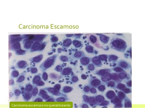 Anomalia Celular En Citologia Cervico Vaginal