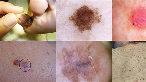 Las Diferentes Caras Que Presenta El Melanoma Maligno Cut Neo Mm