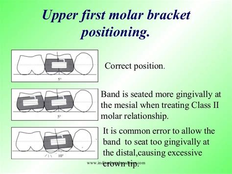 Mbt Technique Certified Fixed Orthodontic Courses By Indian Dental A