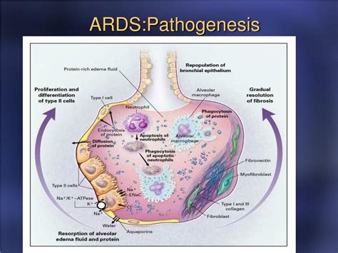 Ppt Ards Powerpoint Presentation Free Download Id3928837