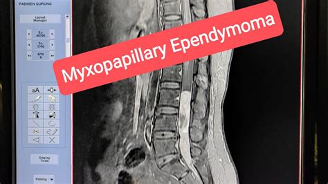 Mri Myxopapillary Ependymoma Mri Lumbar Spine With Contrast Youtube