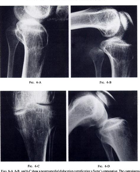 Figure 6 from Subluxation and dislocation of the proximal tibiofibular ...