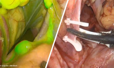 Sentinel Lymph Node Mapping Indocyanine Green Icg Usage In Surgery