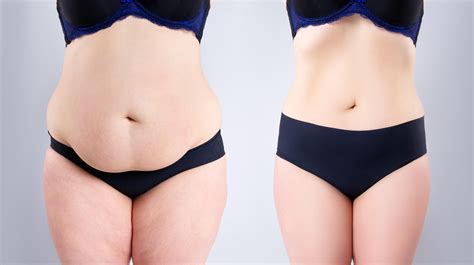 Spectacular Savings For Members Only Tummy Tuck Surgery In Mexico