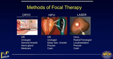 Focal Therapy Of Prostate Cancer Partial Gland Ablation