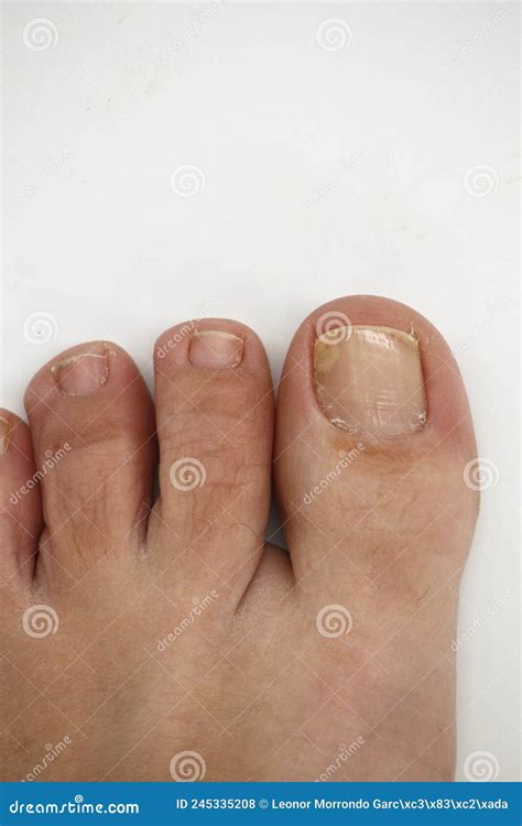 Onychomycosis Or Fungal Nail Infection On Damaged Nails After Gel Polish Onychosis