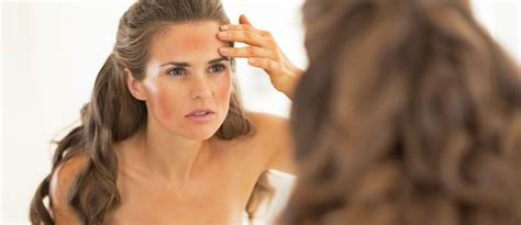 Laser Treatment For Rosacea And Skin Redness Cole Clinic Medispa