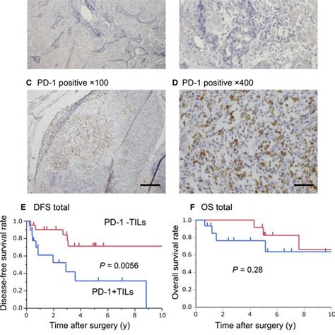 Immunohistochemical Staining Of PDL1 And The Clinical Impact