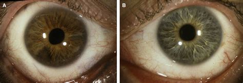 Figure 2 From Iris Melanoma Arising In Iris Nevus In Oculodermal