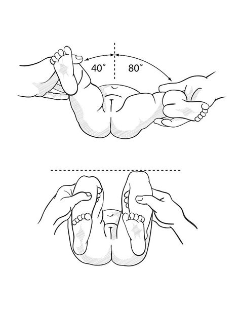 Test For Hip Congenital Hip Dislocation Photograph by Science Photo Library - Pixels