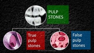 Pulp stone | PPT